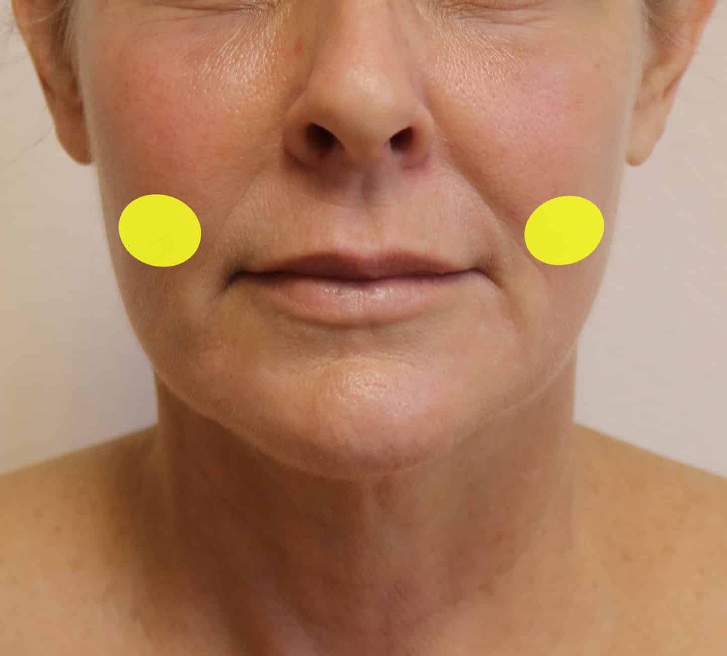 The Difference Between Buccal Fat Pad Removal and Cheek