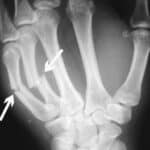 An x-ray of hand bone fractures.