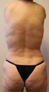 After Image: Liposuction