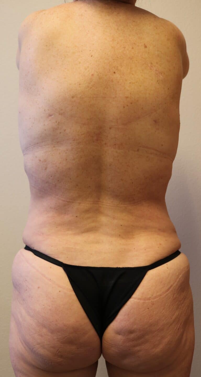 After Image: Liposuction - back