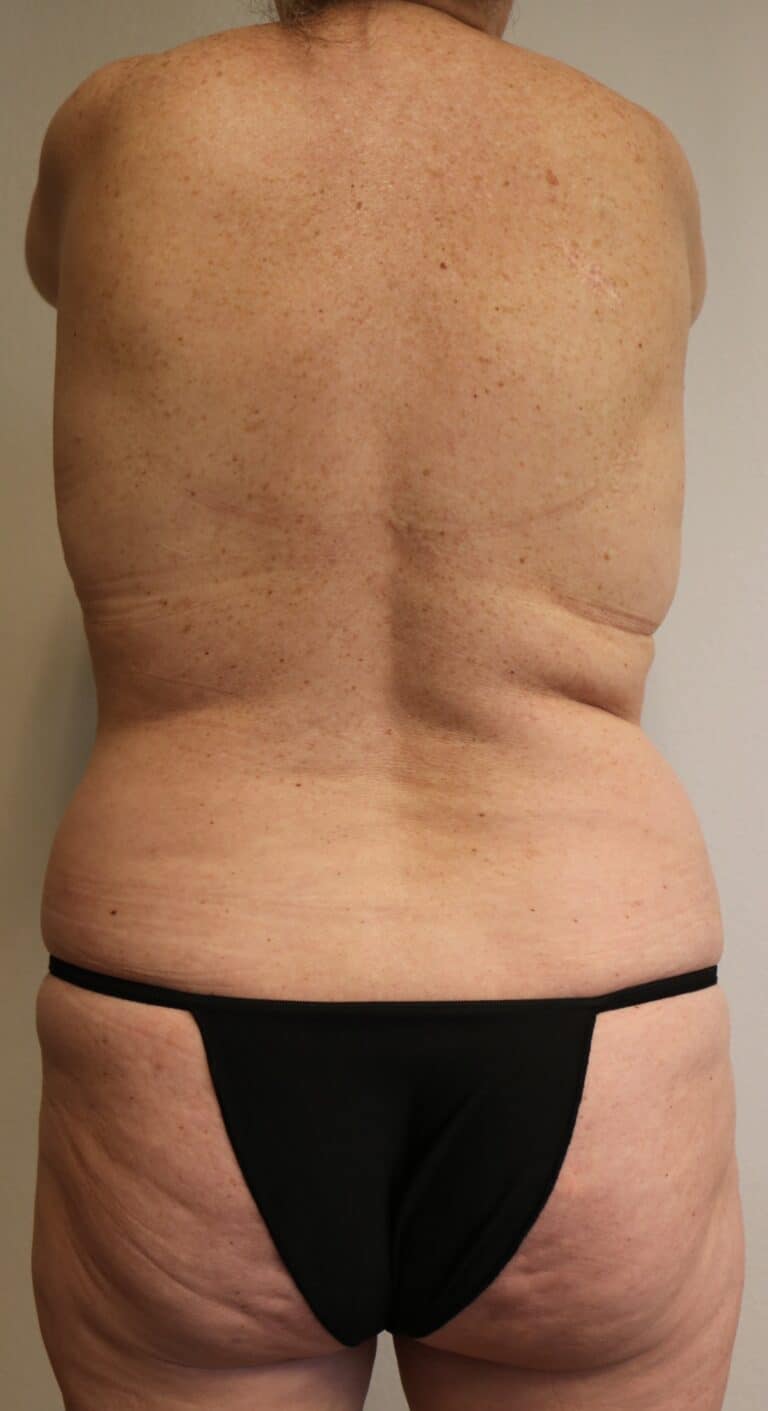 Before Image: Liposuction - back