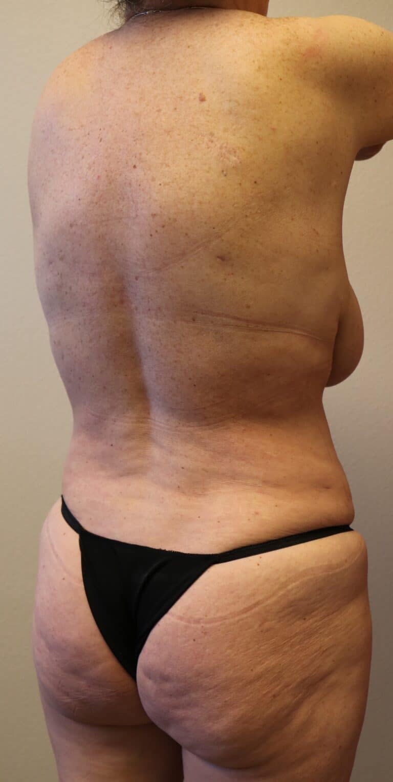After Image: Liposuction - right-back-oblique