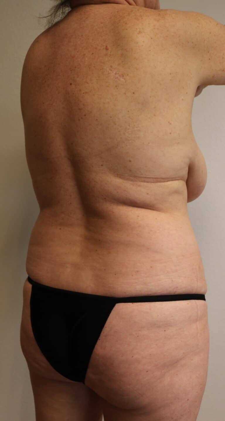 Before Image: Liposuction - right-back-oblique