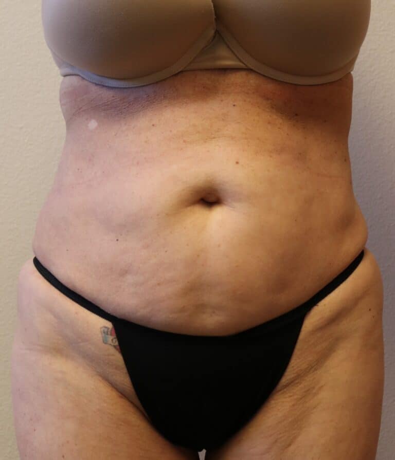 After Image: Liposuction - front