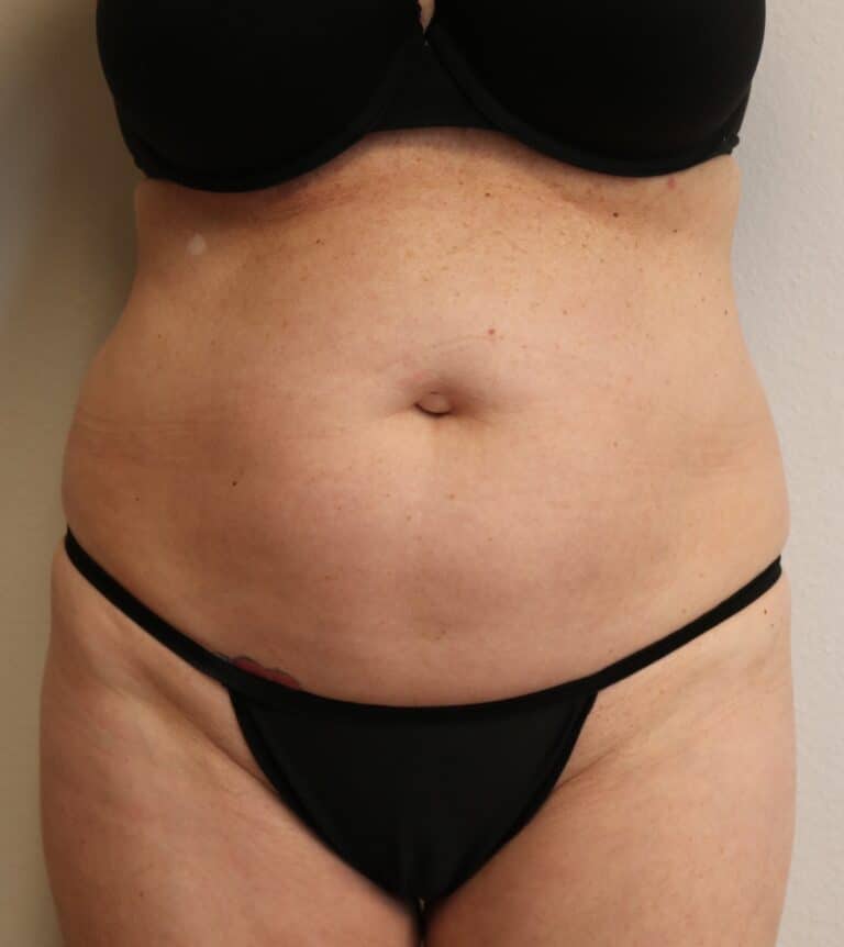 Before Image: Liposuction - front