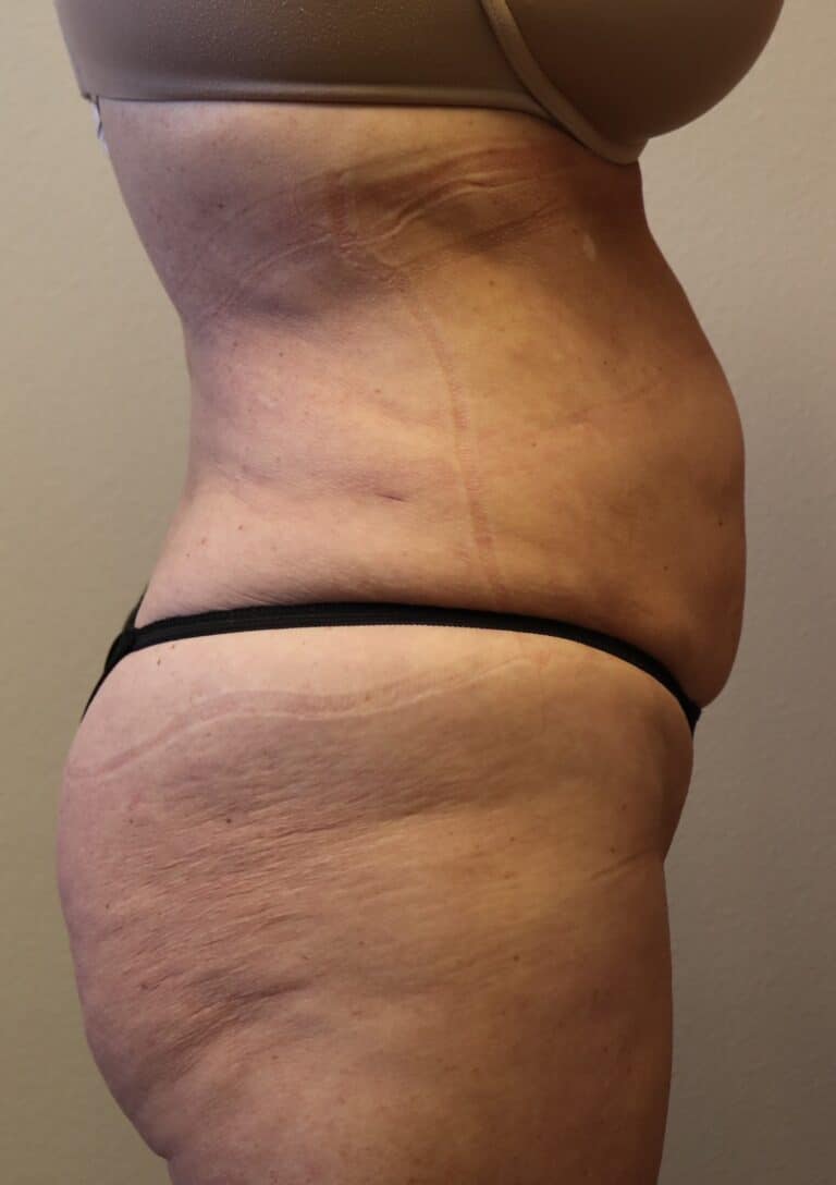 After Image: Liposuction - right-side