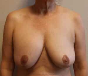 Breast Revision – Fort Worth