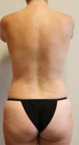 After Image: Liposuction