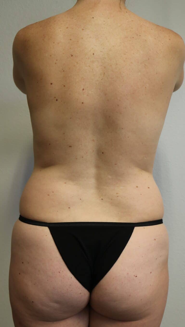 Before Image: Liposuction - back