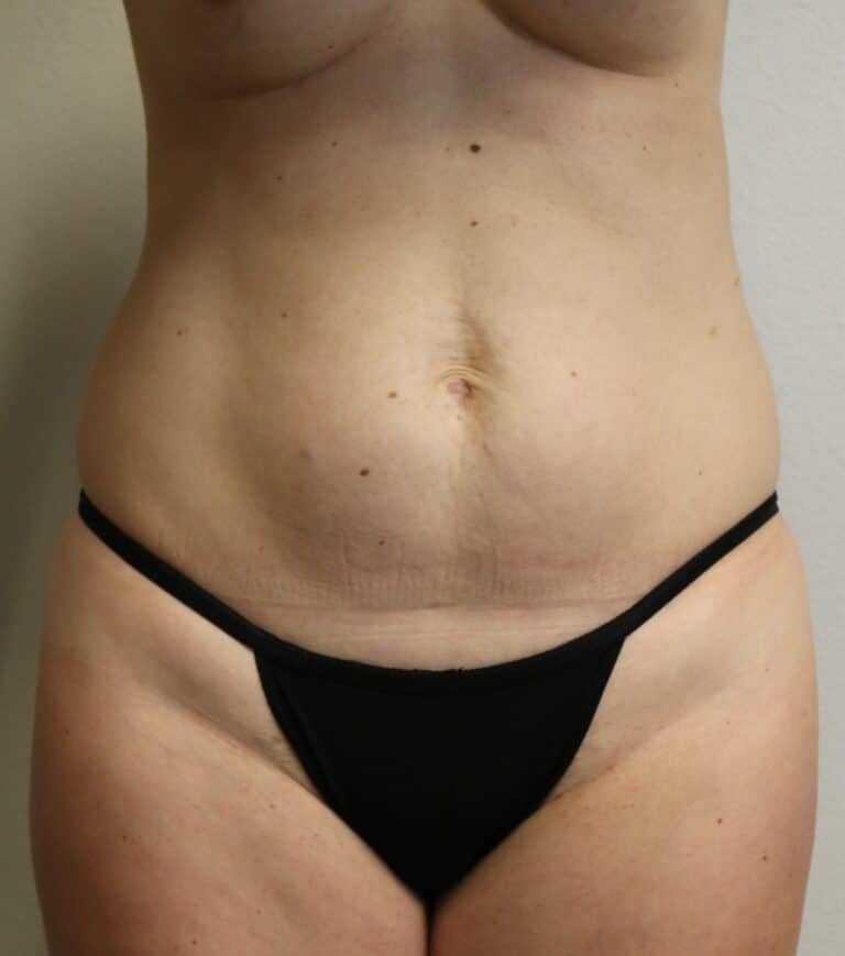 Before Image: Liposuction - front