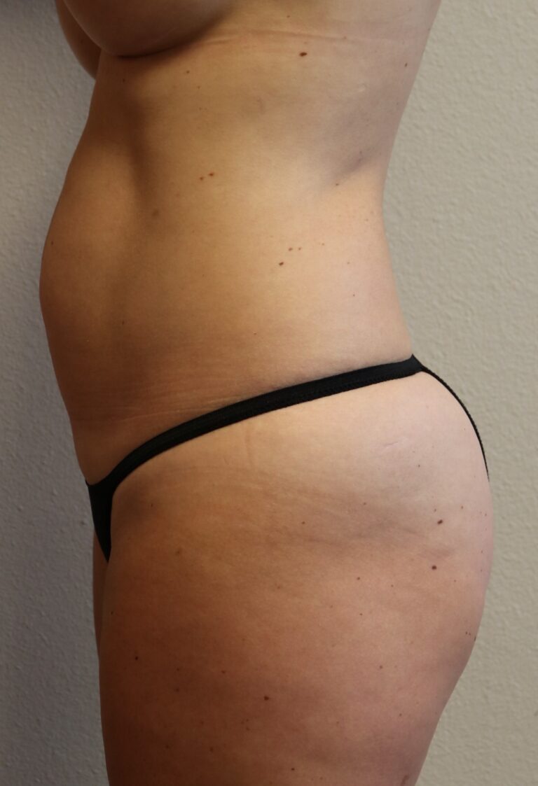 After Image: Liposuction - left-side