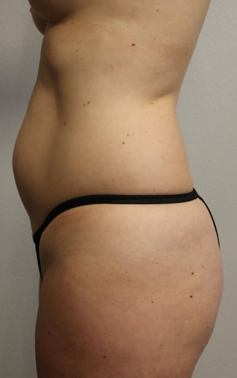 Before Image: Liposuction - left-side