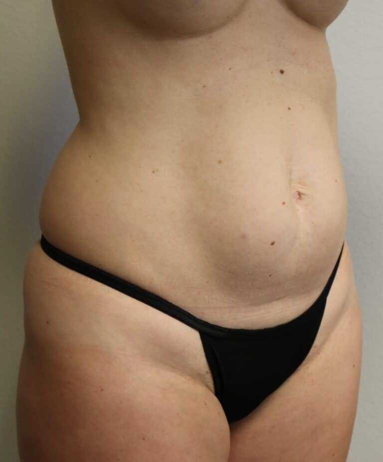 Before Image: Liposuction - right-front-oblique