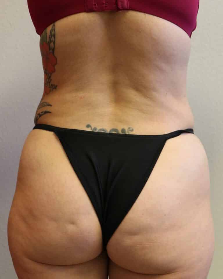 After Image: Liposuction - back