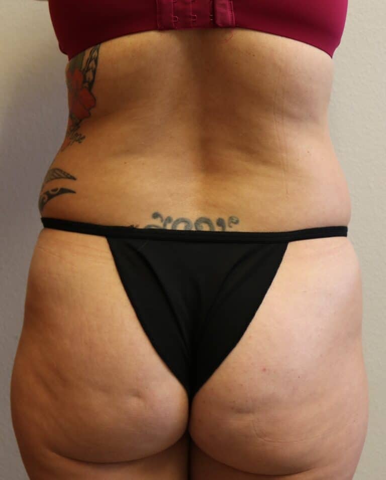 Before Image: Liposuction - back