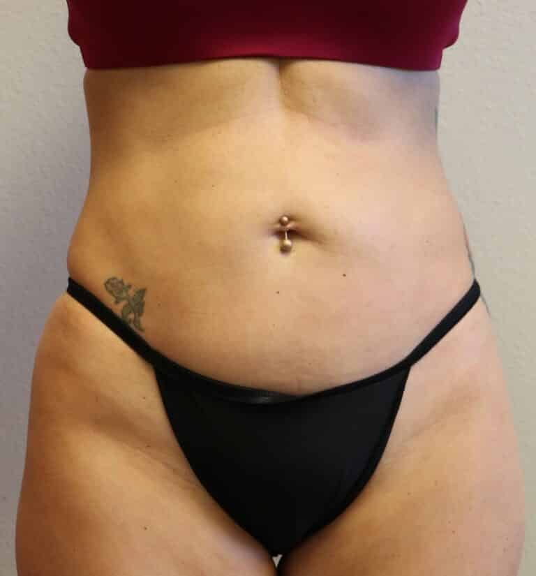 After Image: Liposuction - front