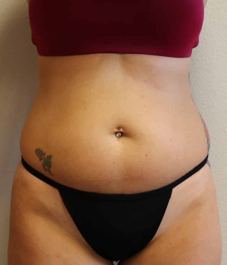 Before Image: Liposuction - front