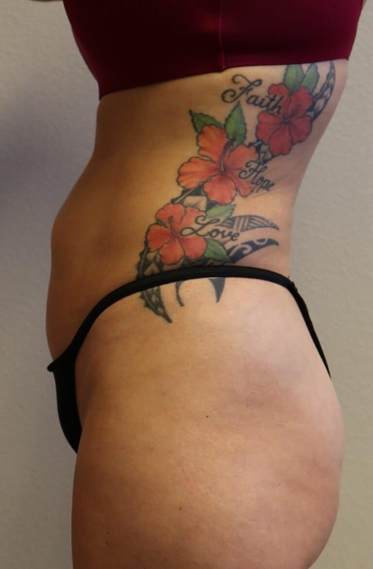 After Image: Liposuction - left-side