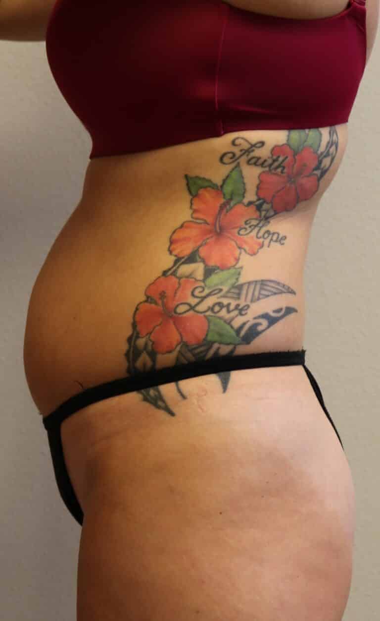 Before Image: Liposuction - left-side