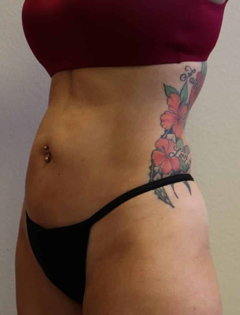 After Image: Liposuction - left-front-oblique