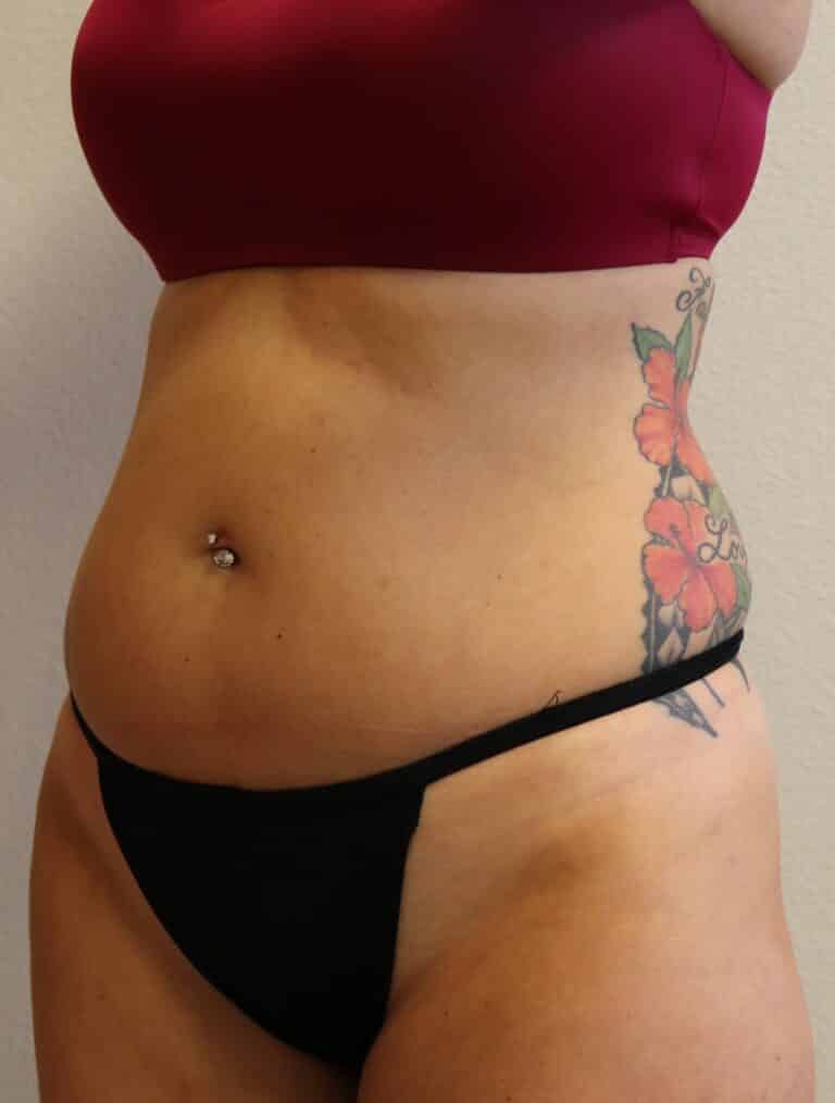 Before Image: Liposuction - left-front-oblique
