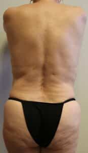 After Image: Liposuction in Fort Worth