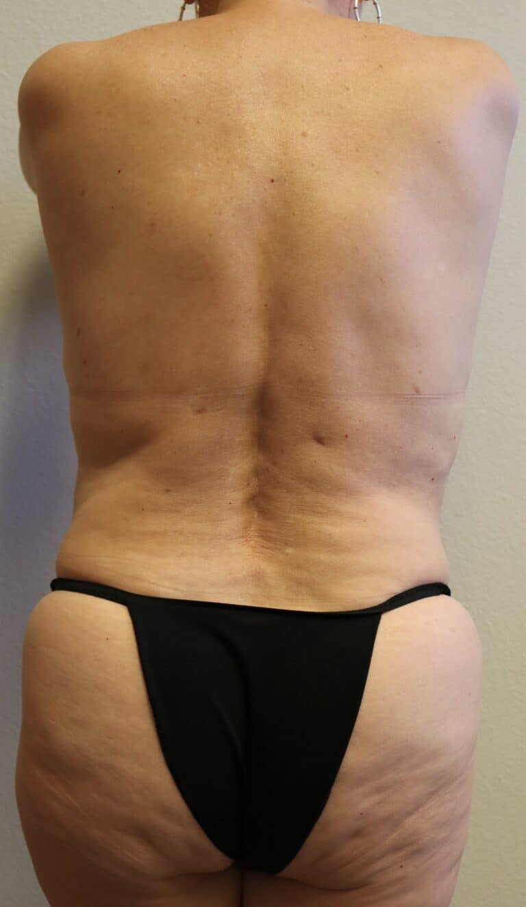 After Image: Liposuction in Fort Worth - back