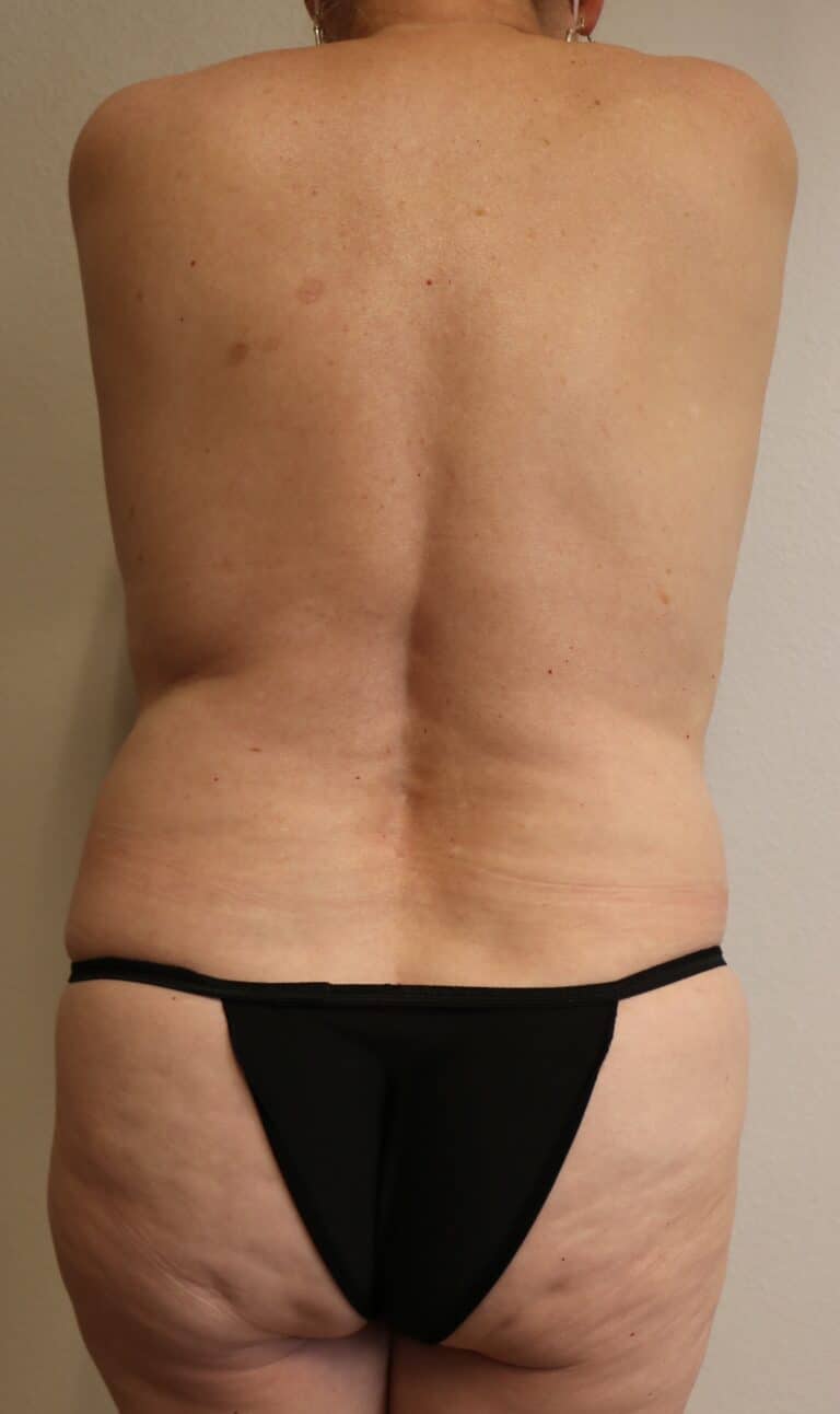 Before Image: Liposuction in Fort Worth - back