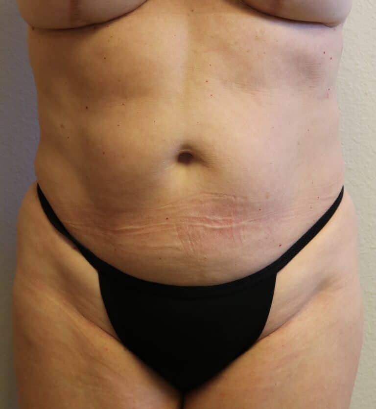 After Image: Liposuction in Fort Worth - front