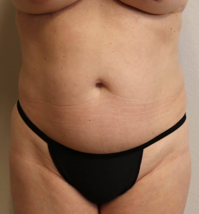 Before Image: Liposuction in Fort Worth - front