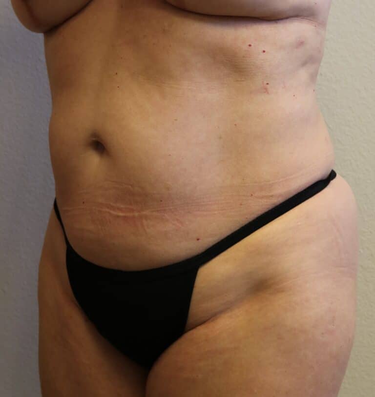 After Image: Liposuction in Fort Worth - left-front-oblique