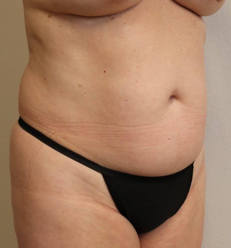 Before Image: Liposuction in Fort Worth - right-front-oblique