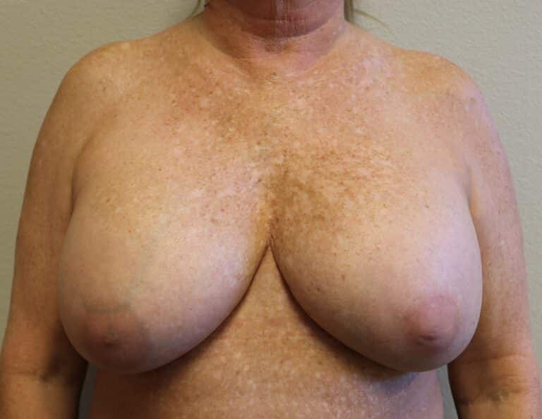 After Image: Ruptured Breast Implant - front