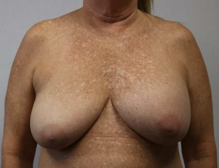 Before Image: Ruptured Breast Implant - front