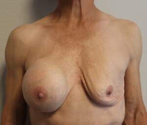 Before Image: Ruptured Breast Implant