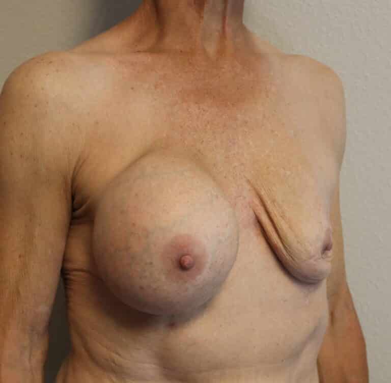 Before Image: Ruptured Breast Implant - right-front-oblique