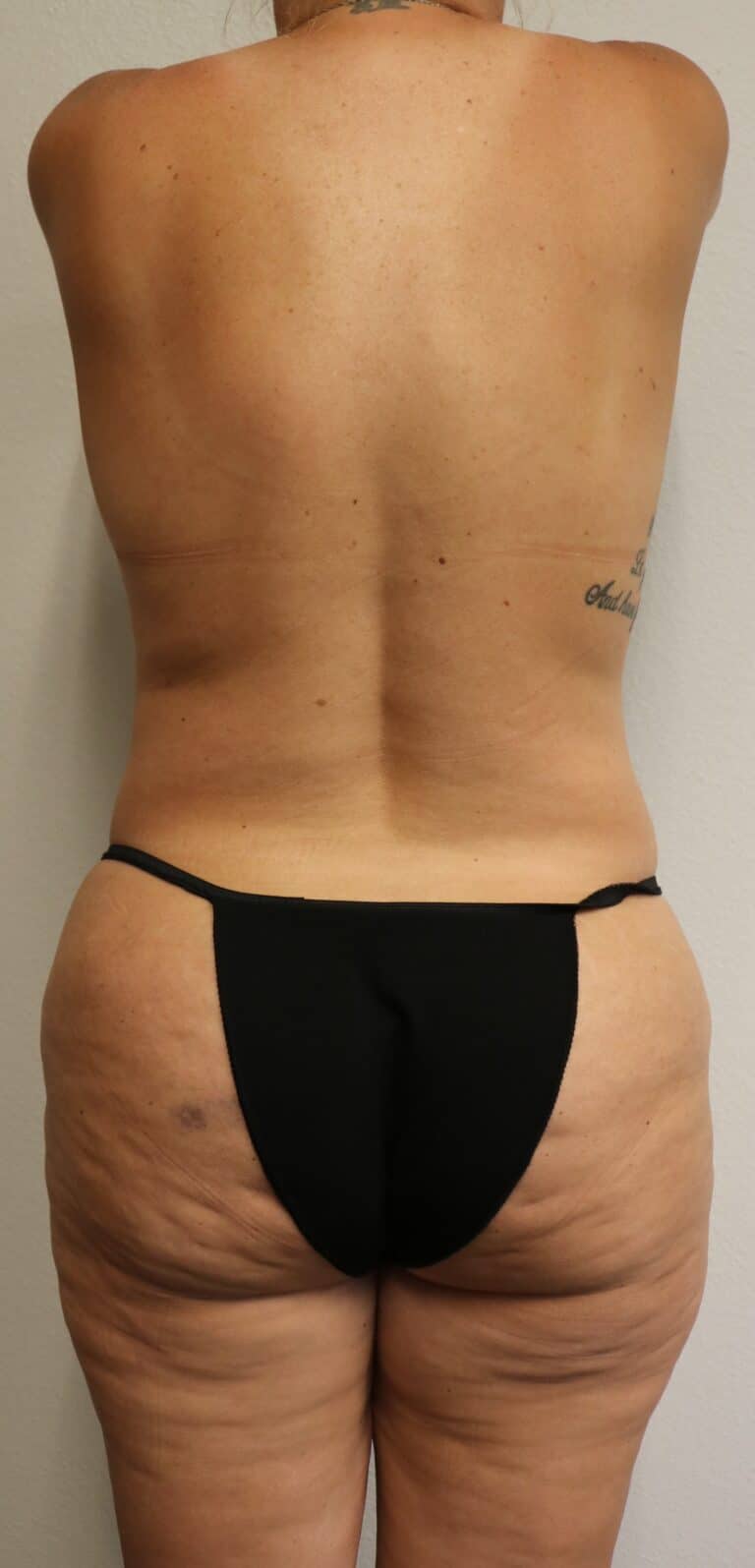 After Image: Liposuction in Fort Worth - back