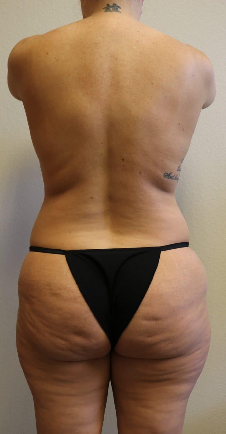 Before Image: Liposuction in Fort Worth - back