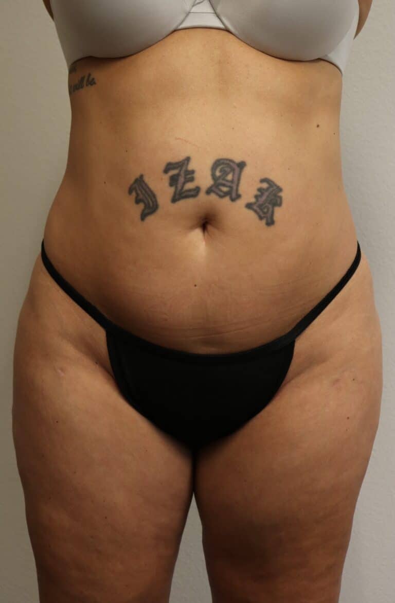After Image: Liposuction in Fort Worth - front