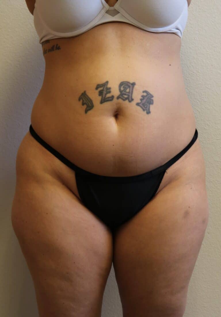 Before Image: Liposuction in Fort Worth - front