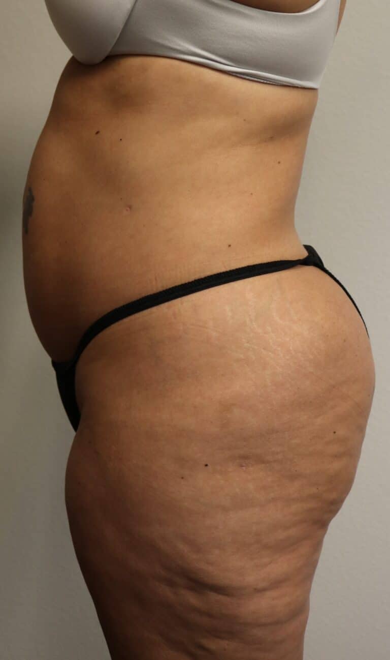 After Image: Liposuction in Fort Worth - left-side