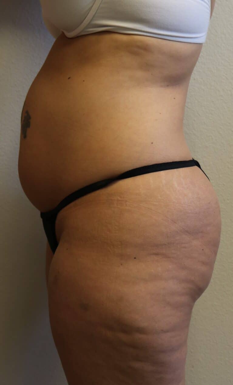 Before Image: Liposuction in Fort Worth - left-side
