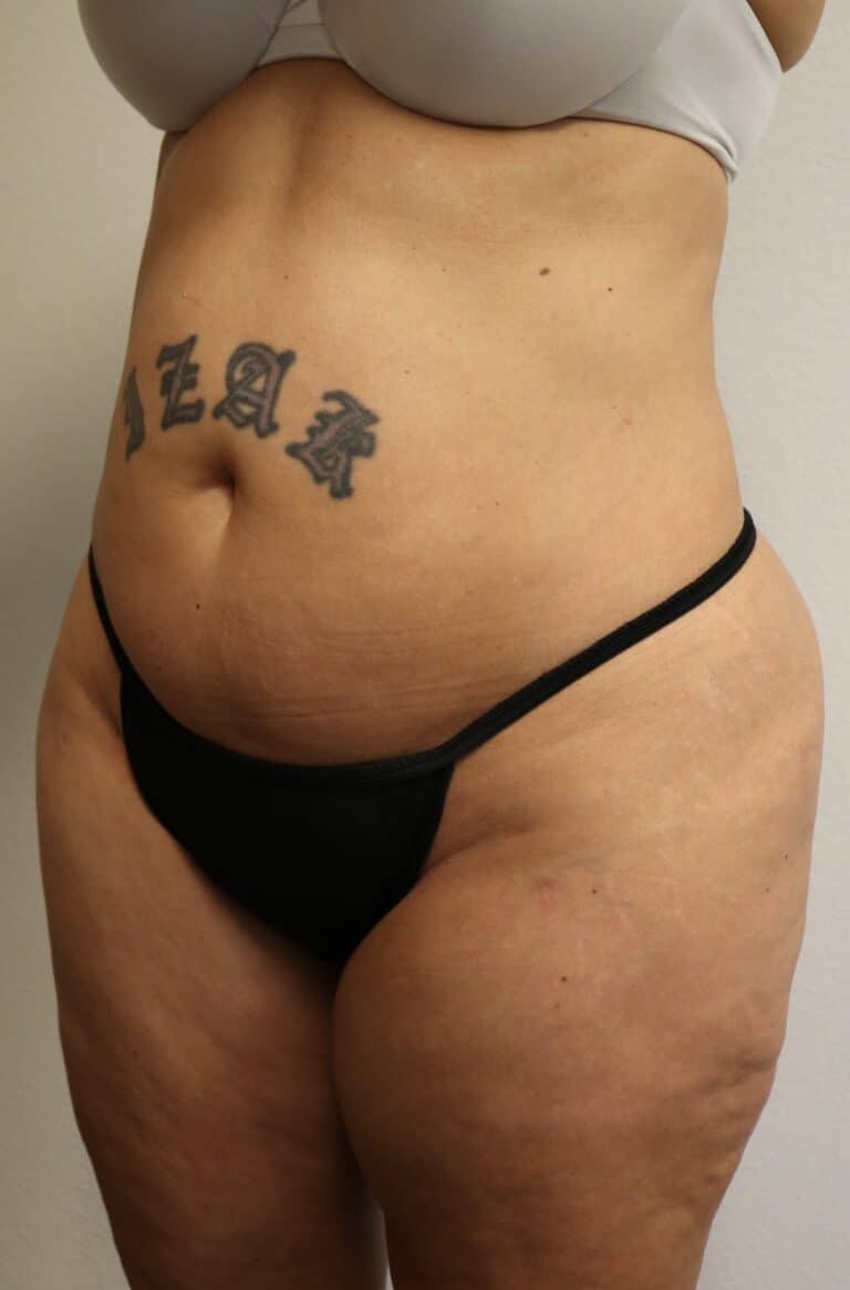 After Image: Liposuction in Fort Worth - left-front-oblique