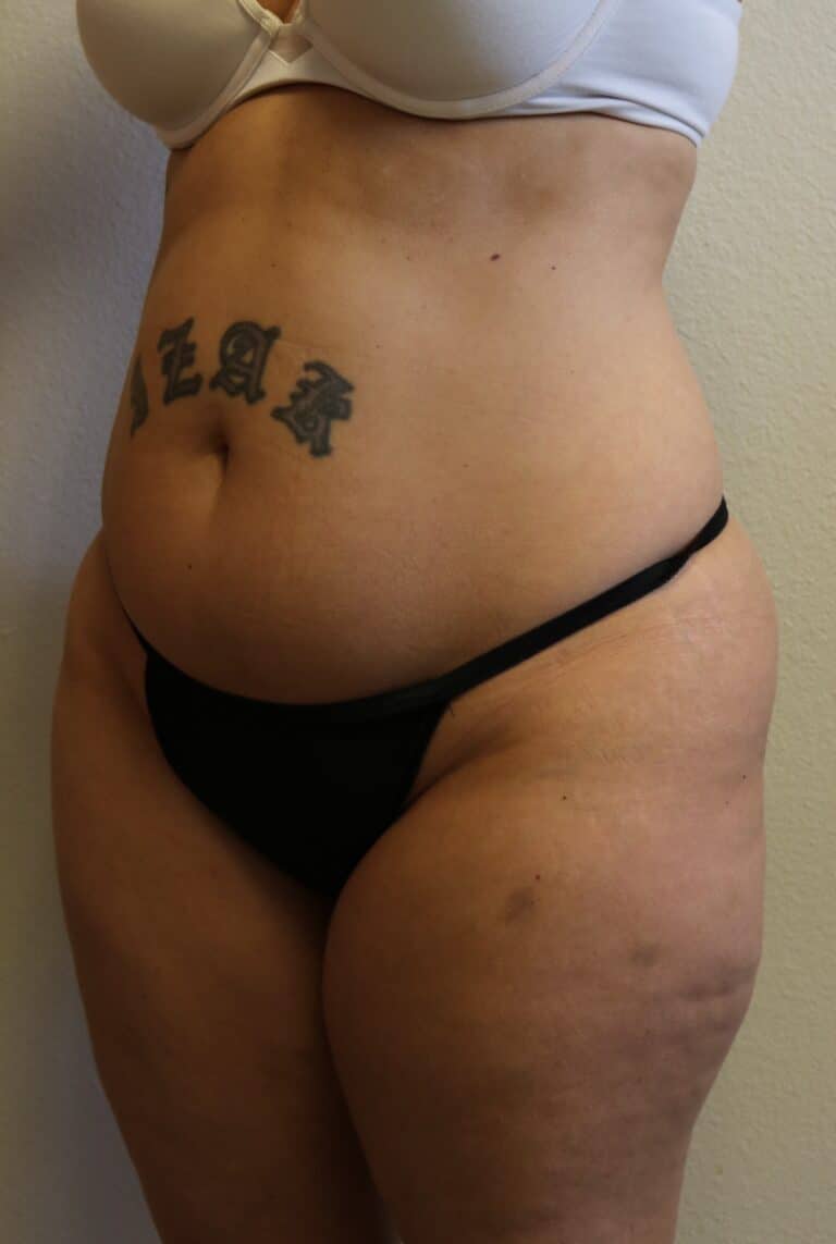 Before Image: Liposuction in Fort Worth - left-front-oblique