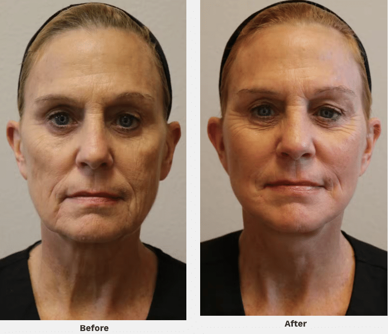 Before and After Image of Facelift Procedure Fort Worth TX