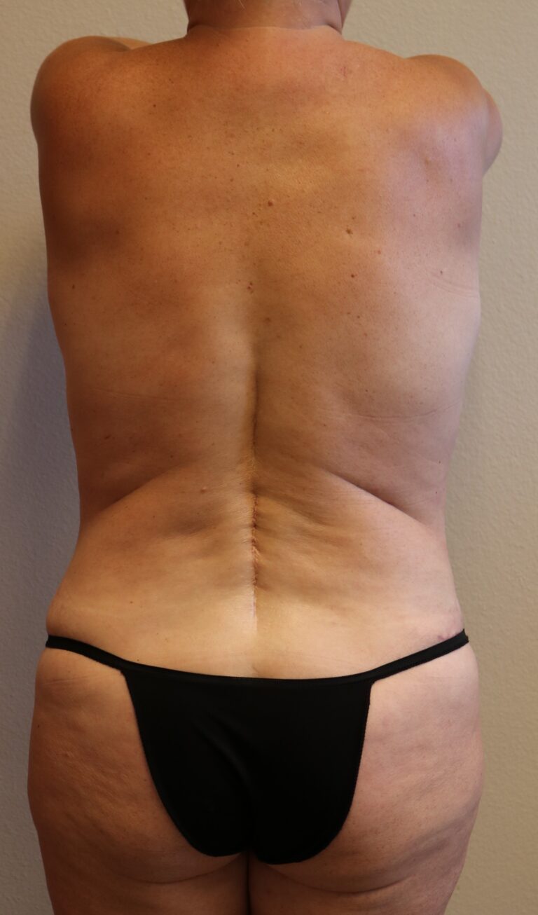 After Image: Tummy Tuck - back