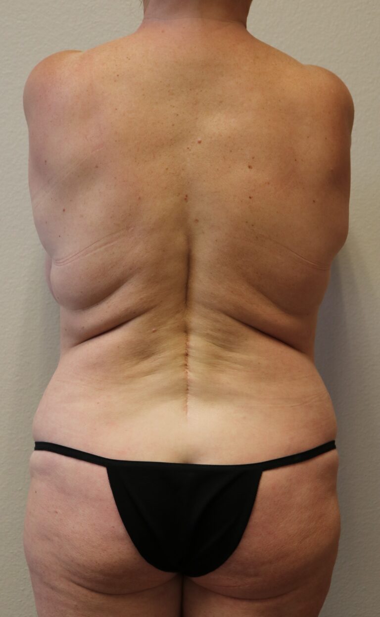 Before Image: Tummy Tuck - back