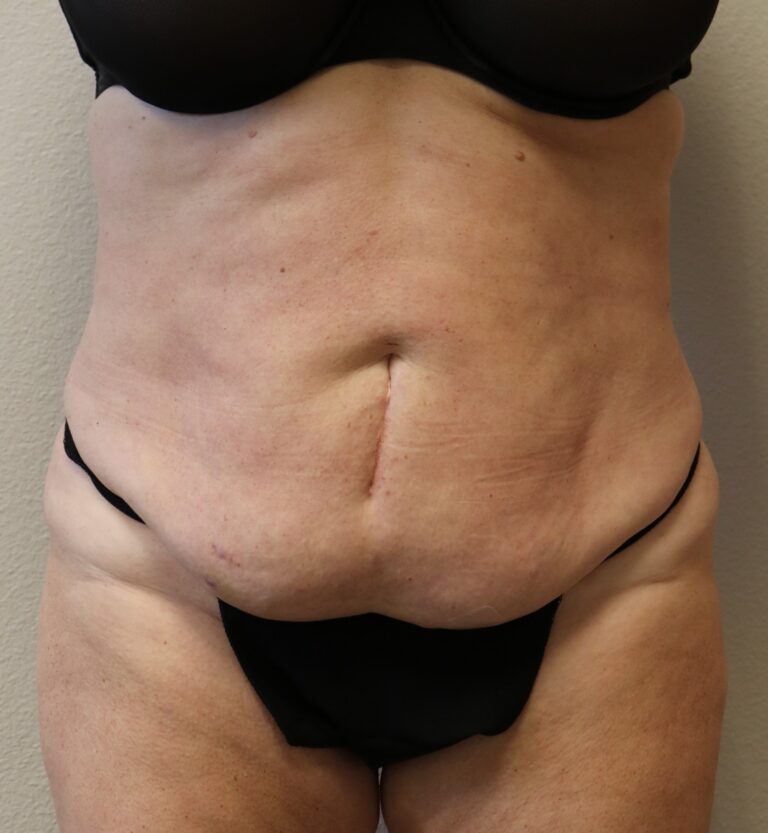 Before Image: Tummy Tuck - front