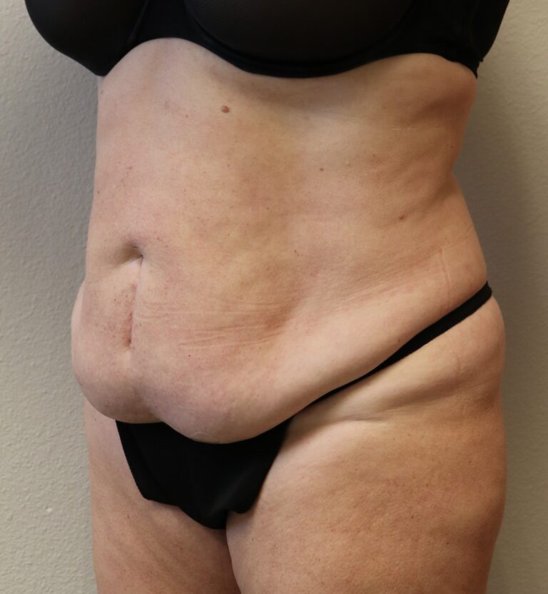 Before Image: Tummy Tuck - left-front-oblique