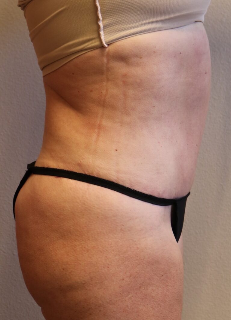 After Image: Tummy Tuck - right-side